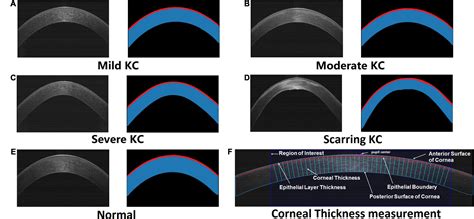 instrument measure thickness of cornea|thin cornea thickness chart.